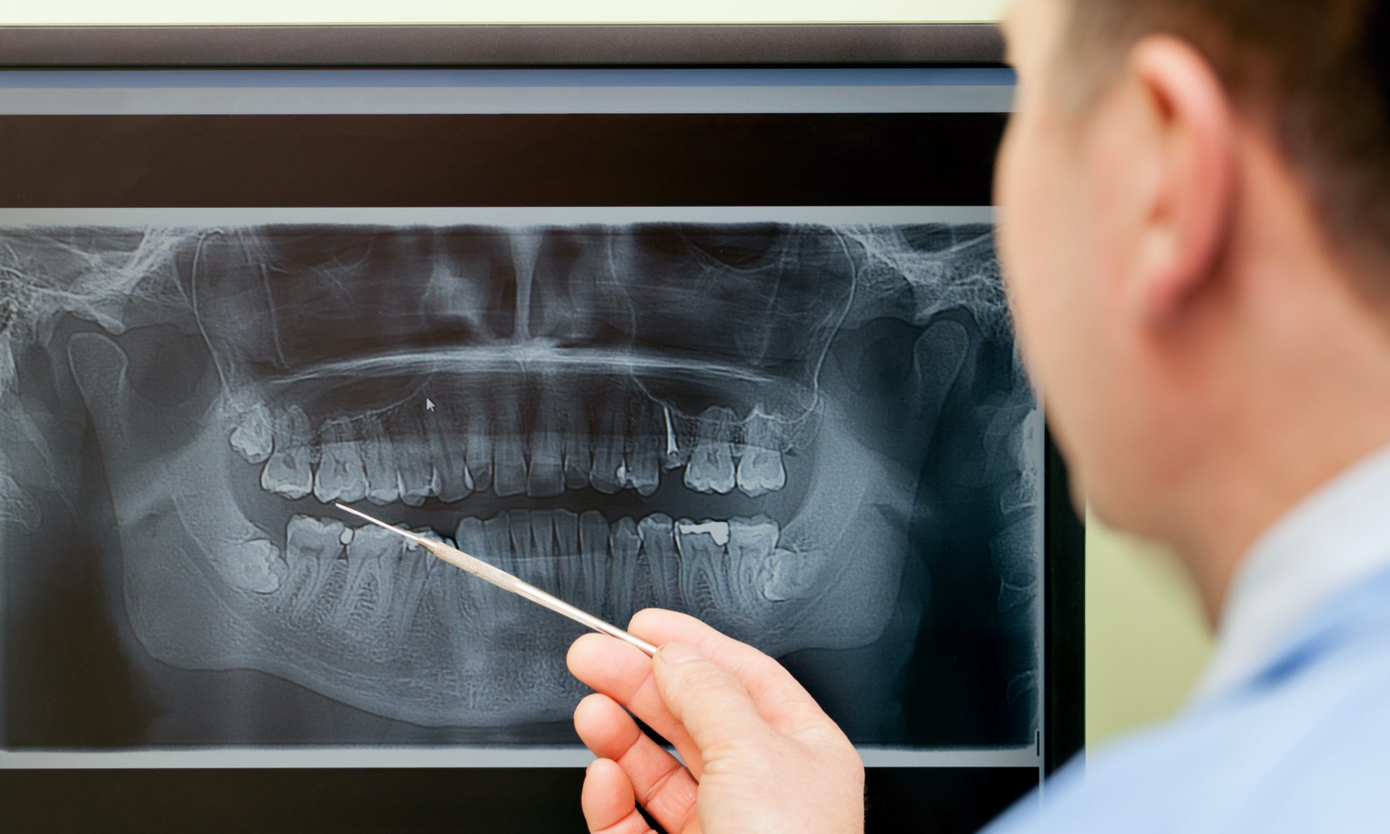 Beach Dentists Newport Beach | Northern Beaches Dentists - Inlays & Onlays