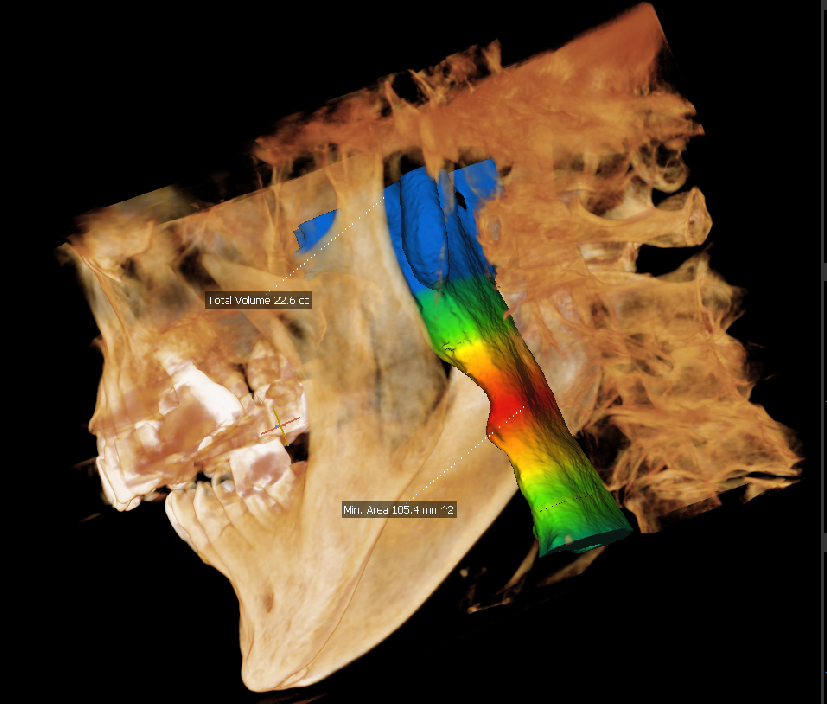 beach dentists sleep apnea assistance