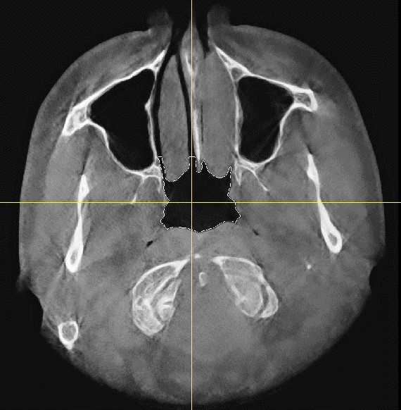 airway turbinates sinus blockage