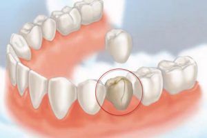 crowns-at-beach-dentists-newport