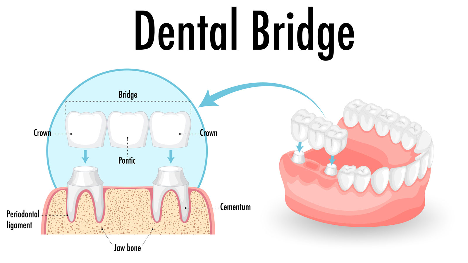 Dental-bridge-explained-Beach-Dentists-Newport